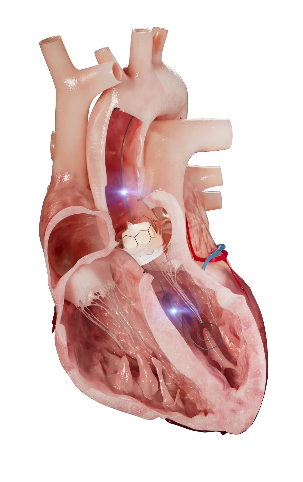 Anatomical heart showing Xenter's wireless technology